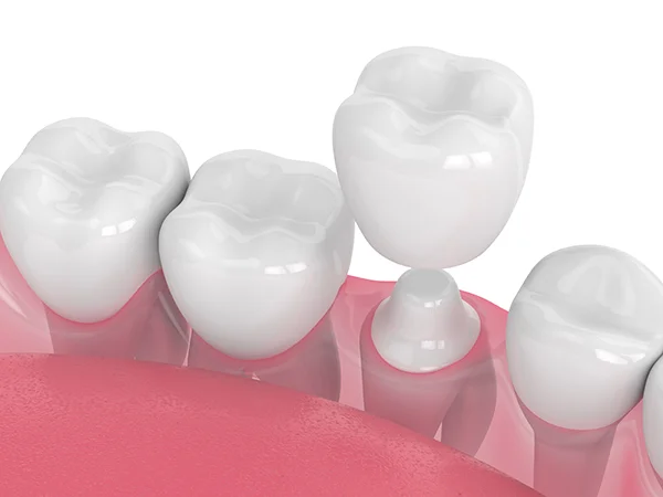 Close up 3D rendering of a dental crown being placed on a shaved down tooth.