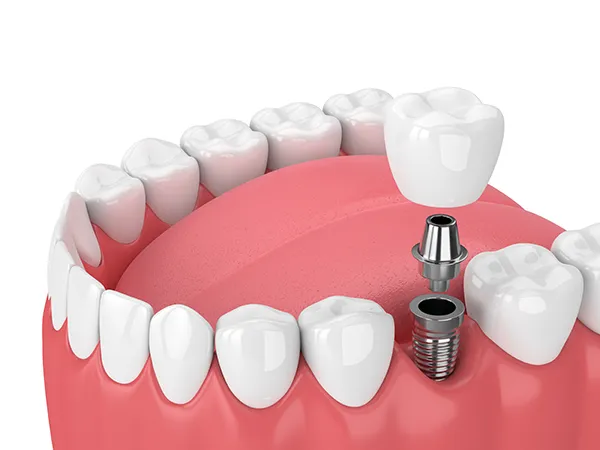 3D rendering of a dental implant and its components (screw, abutment, and crown) being placed into the jaw.